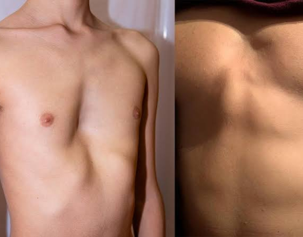 ¿El pectus excavatum y el pectus carinatum están relacionados con ser delgado?