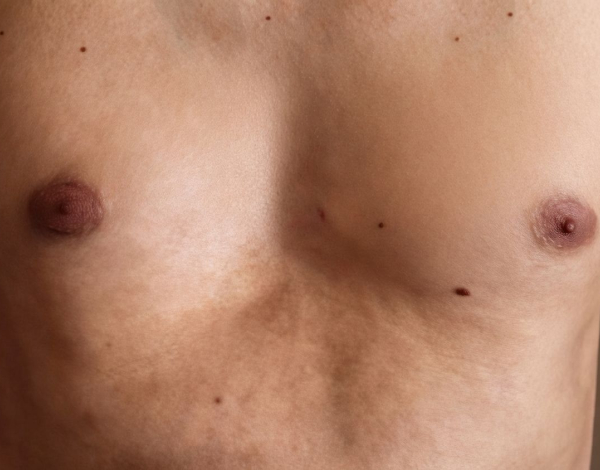 Cirugía para pectus excavatum en adultos: la experiencia de un paciente que decidió corregir su pecho hundido