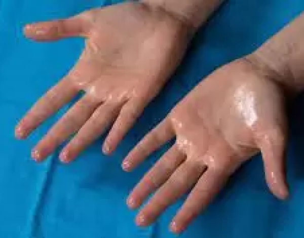 Sudoración Excesiva: Innovación en el tratamiendo del Dr. Gómez