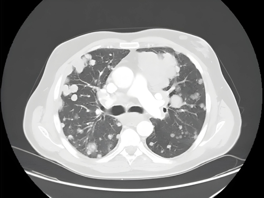 Metástasis pulmonares