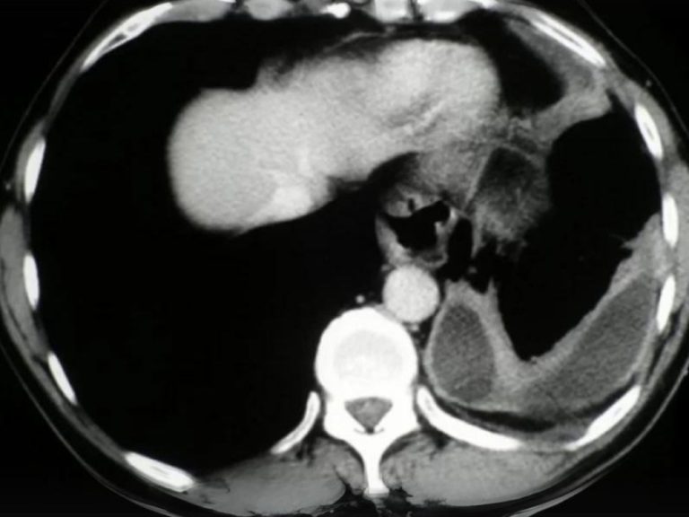 Enfermedades de la pleura