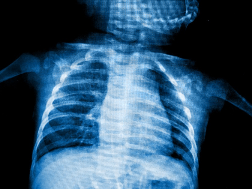 Traumatismo Torácico