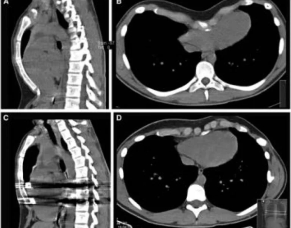 Arritmias ventriculares resueltas por corrección de pectus excavatum