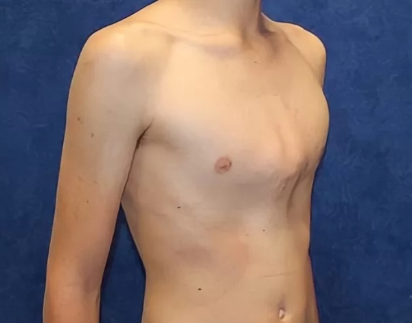 Pectus Carinatum o Pecho de paloma
