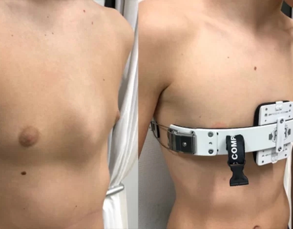 Tratamientos para el Pectus Carinatum
