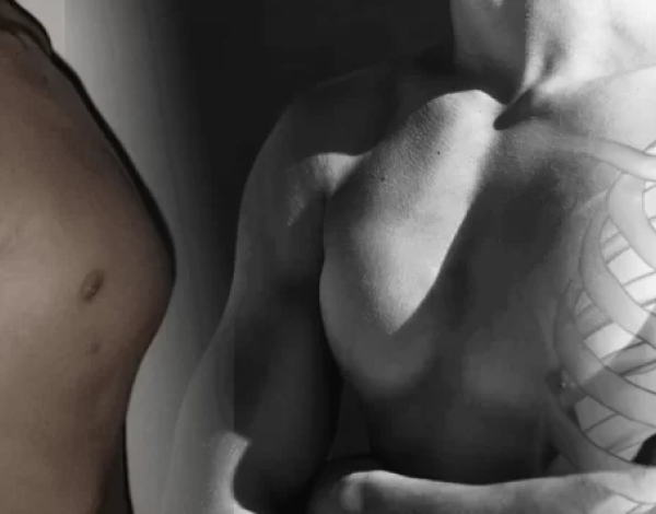 Pectus Carinatum: ¿Se puede prevenir?