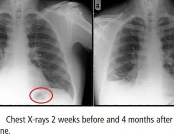 Casos extraños de cáncer de pulmón