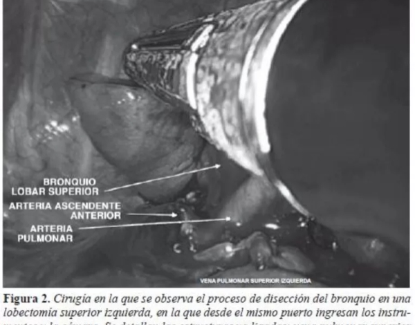 Debate sobre las ventajas de la Lobectomía Pulmonar por Puerto Único