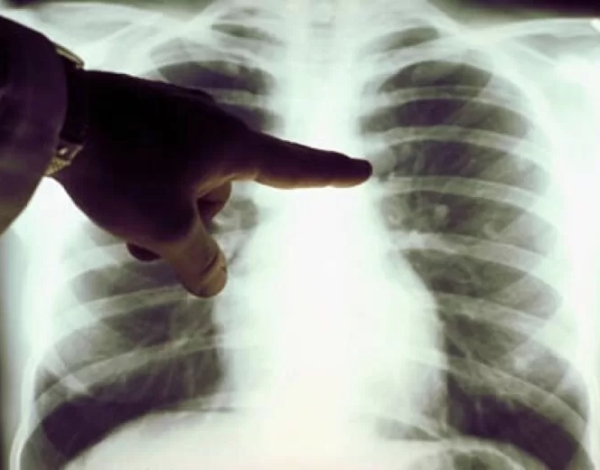 Cirugía Torácica Mínimamente Invasiva