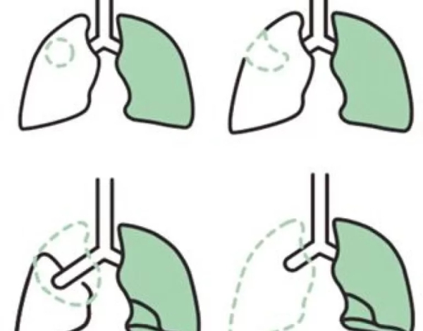 Lobectomía uniportal, lobectomía pulmonar