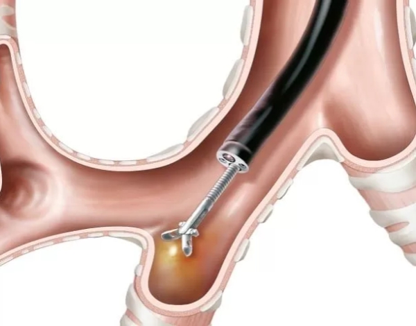 La Biopsia Pulmonar Abierta generan menos complicaciones y es muy rentable para el diagnóstico