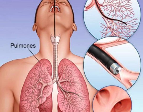 Biopsia pulmonar quirúrgica para establece un diagnóstico histopatológico en pacientes