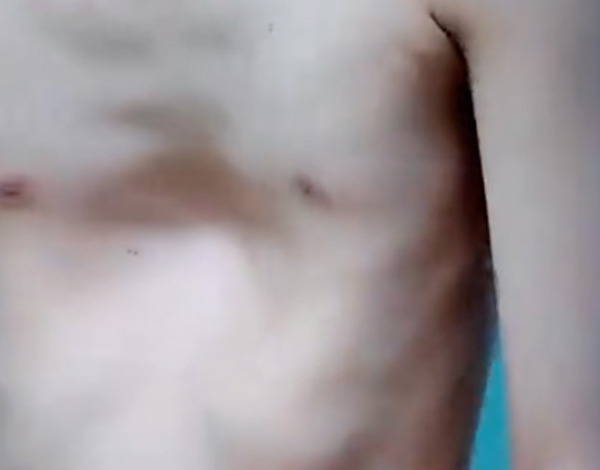 Pectus excavatum : corrección definitiva con cirugía Mini-Ravitch en niños y adolescentes