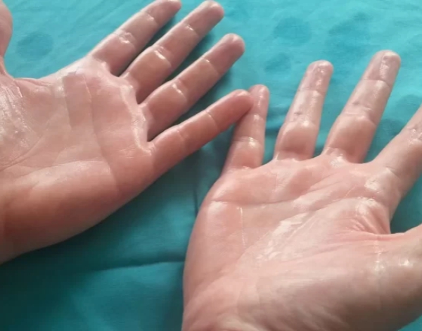 ¿Te sudan las manos, axilas o pies? La hiperhidrosis sí tiene solución definitiva