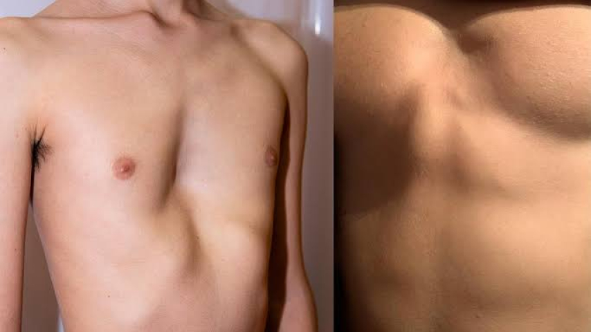 ¿El pectus excavatum y el pectus carinatum están relacionados con ser delgado?