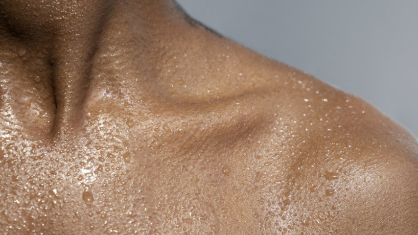 ¿La sudoración excesiva afecta tu vida? La hiperhidrosis tiene solución definitiva