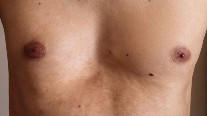 Cirugía para pectus excavatum en adultos: la experiencia de un paciente que decidió corregir su pecho hundido