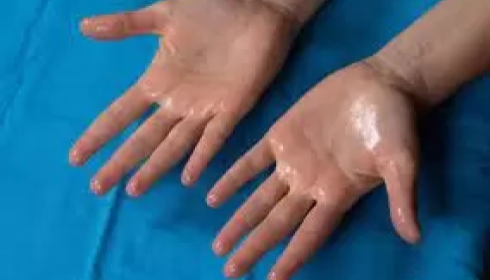 Sudoración Excesiva: Innovación en el tratamiendo del Dr. Gómez