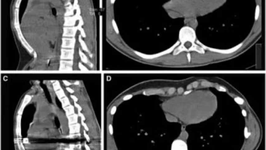 Arritmias ventriculares resueltas por corrección de pectus excavatum