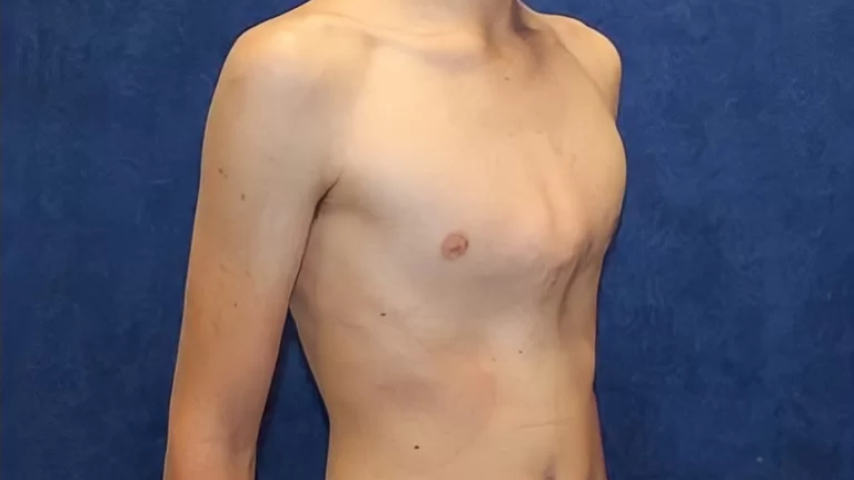 Pectus Carinatum o Pecho de paloma