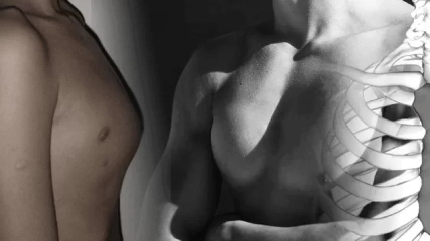 Pectus Carinatum: ¿Se puede prevenir?