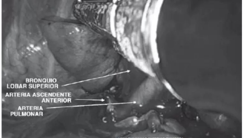 Debate sobre las ventajas de la Lobectomía Pulmonar por Puerto Único