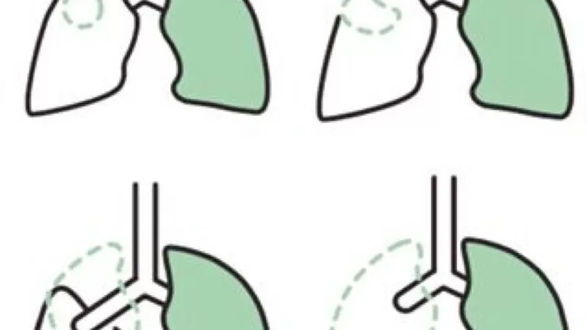 Lobectomía uniportal, lobectomía pulmonar