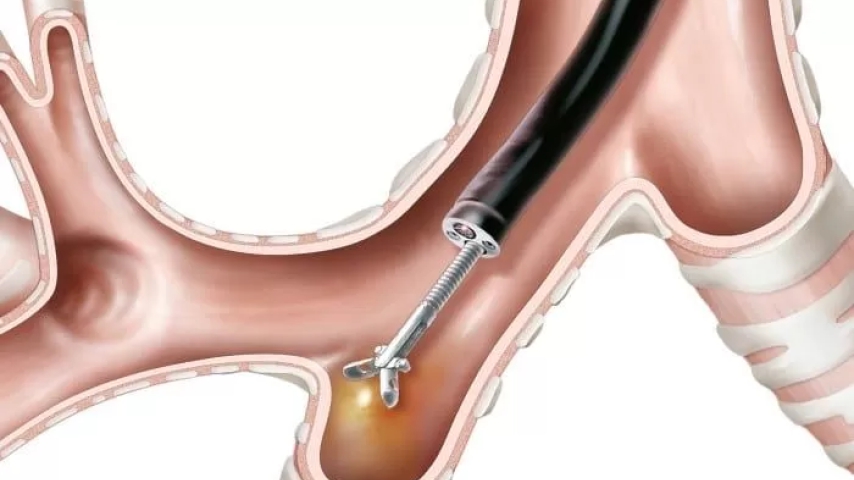 La Biopsia Pulmonar Abierta generan menos complicaciones y es muy rentable para el diagnóstico