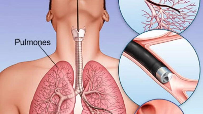 Biopsia pulmonar quirúrgica para establece un diagnóstico histopatológico en pacientes