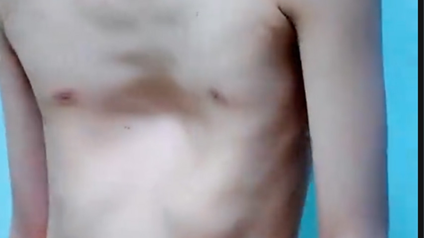 Pectus excavatum : corrección definitiva con cirugía Mini-Ravitch en niños y adolescentes