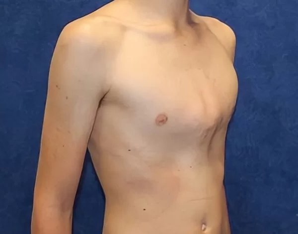 Pectus carinatum: qué es el pecho de paloma y tratamiento