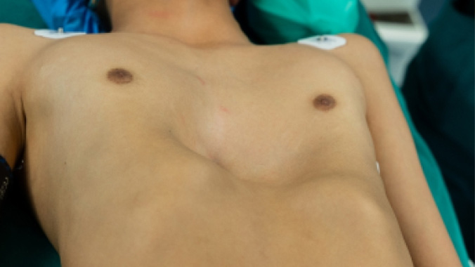 Técnica Mini Ravitch Pectus: corrección segura de la pared torácica