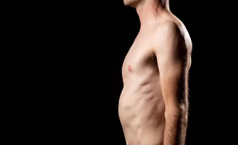 Pectus Excavatum: Modernas cirugías